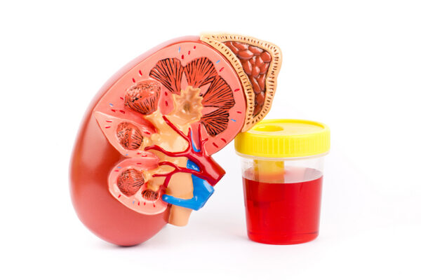 Illustration of kidney and bloody urine